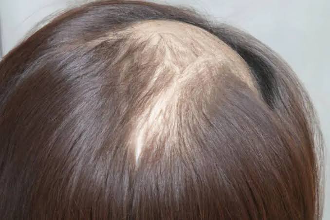 Why hair loss after pregnancy feels alarming but is completely normal