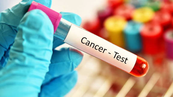 New Blood Test Detects Over 50 Types of Cancer, Offering Hope for Earlier Diagnosis