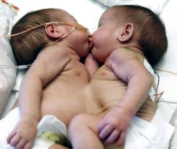CONJOINED REMAINING TWIN TRANSFERRED TO STEVE BIKO HOSPITAL