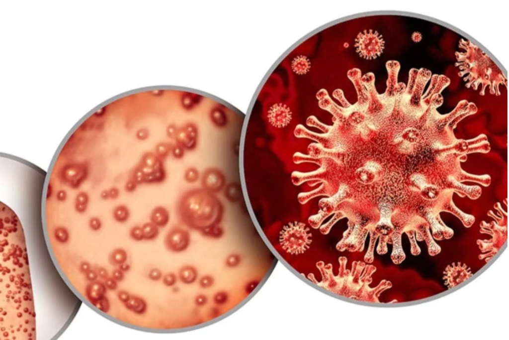 Mpox Cases Rise To 22 In South Africa