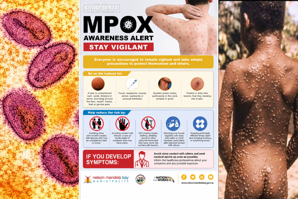 South Africa’s Mpox Total Climbs to 26 as Department of Health Confirms Four New Cases